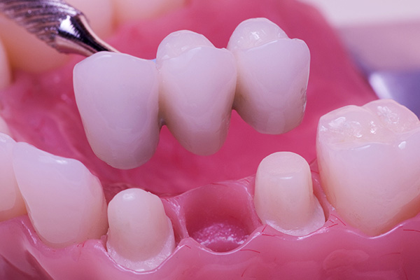 dental veneers in pragathi nagar